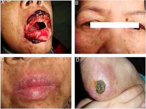 Patient's clinical manifestations. (A) Dermatological examination revealed typical hemorrhagic crusting ulcers on the lips, as well as white-to-yellow exudates and erosions on the lateral surface of tongue; (B) red papules on the face and eyelids, and conjunctiva congestion and erosion in the right eye; (C) skin lesions healed in two months and oral ulcers in six months after removal of the associated follicular dendritic cell sarcomas. No recurrent mucocutaneous lesions were found in four years; (D) Hyperkeratosis on her metatarsus large ulcer with hemorrhagic crust on the heel.