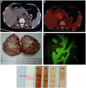 Image exams, macroscopical observation of the tumor, and identification of autoantibodies in patient