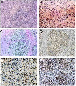 Histopathology and immunochemistry staining of the tumor. (A) Histological examinations showed several areas with storiform arrangement of a large number of spindle or ovoid dendritic tumor cells, intermingled with small lymphocytes and many blood vessels in the background, along with occasional fibrous bands (hematoxylin & eosin staining, ×100). (B) Chromatin of the spindly tumor cells is vesicular; small nucleoli are present. There is mild-to-moderate variation in nuclear size (hematoxylin & eosin staining, ×200). (C) Residual follicles observed between the storiform tumor areas with the presence of serpentine and polyvascular follicles typical of cases of hyaline-vascular Castleman