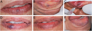 (A) Initial clinical appearance of vascular malformation, purplish vesicle measuring 3mm on lower lip (patient 16); (B) positive diascopy for vascular lesion performed during clinical examination; (C) application of monoethanolamine oleate 5% with positive aspiration of blood in the vascular lumen; (D) clinical appearance of lesion on seventh day post-procedure; (E) final clinical appearance of vascular lesion on 28th day post-procedure; (F) final negative diascopy of the region where the VM was previously located.