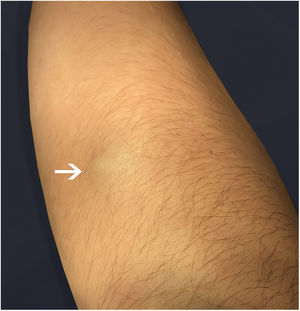 Fibroelastic subcutaneous nodule with imprecise limits and bluish coloration.