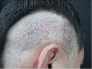 Multiple, firm, violaceous, hyperkeratotic plaques and nodules on the scalp.