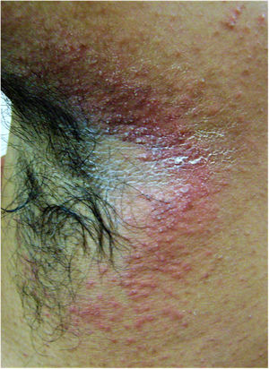 Clinical image of tinea incognito lesion over the right axilla of a young male – minimally raised erythematous plaque with ill-defined borders, shiny surface with peripherally scattered, mildly scaly papules. Onset four months previously; history of intermittent application of steroid-antifungal cream and oral itraconazole intake.