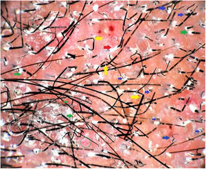 Polarized dermoscopic image of the lesion revealed patchy erythema, perifollicular scales (green arrow), and casts (red arrow), black dots, broken hairs, and comma and cork-screw hairs (blue arrows). The entire field is filled with translucent and deformable hairs with bends (yellow arrows), and Morse-code hairs showing horizontal skip white bands. Additionally, dotted vessels (green circle) and scattered telangiectasias (green arrows) were seen. The larger red blotches represent excoriation-induced, dried up blood-crusts (Dermlite 4, ×20).