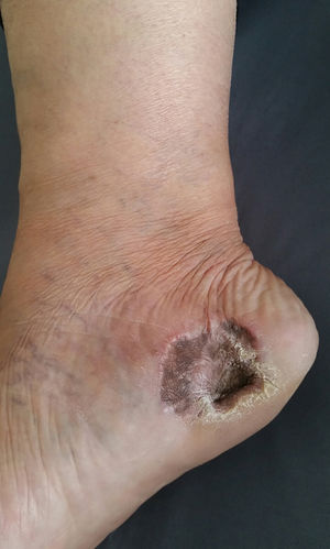 Final result after full thickness skin graft. Note the partial loss of the full thickness skin graft and the intense local hyperchromia all over the graft attachment site.