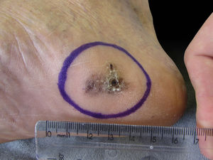 Preoperative aspect. Initial aspect of acral melanoma, excised with secondary intention healing.