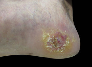 Final result after secondary intention healing. Photo taken after 12 weeks of follow up.