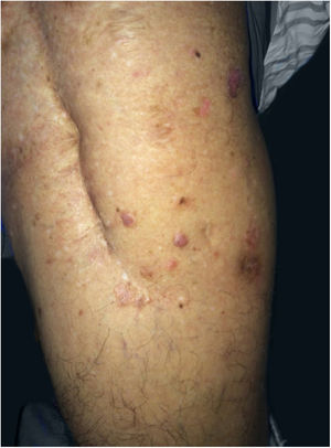 Presence of translucent erythematous papules, discreetly raised red-brown plaques adjacent to the surgical scar in the left thigh. Anterolateral view.