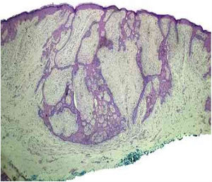 Epithelial proliferation infiltrating the dermis, with anastomoses that had a cord-like appearance, accompanied by surrounding desmoplasia (hematoxylin & eosin, ×4).