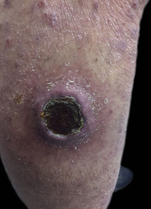 Ulcer with crust centers on the left lower limb.