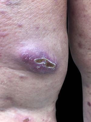 Nodular lesion on the right lower limb.
