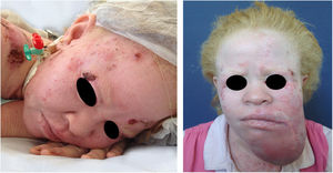 Morbimortality associated with skin cancer. Young albino patient, presenting multiple ulcerated tumors. He died at age 27 due to metastatic squamous cell carcinoma.