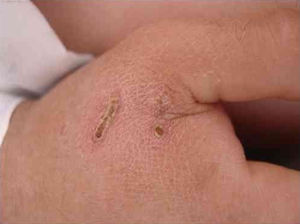 Lesions caused by cat scratches presented by a 28-year-old man with Bartonella sp. infection detected by polymerase chain reaction.