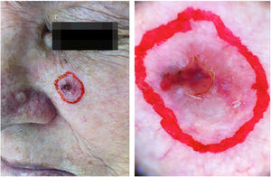 Tumor delimitation with dermatoscope.