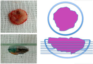 Debulking image and demonstration of how the incisions were made (horizontal incisions from the surface to the depth of the tumor).
