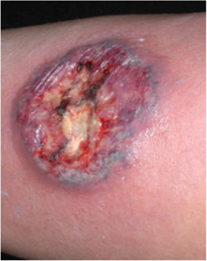 Classic or ulcerative pyoderma gangrenosum.