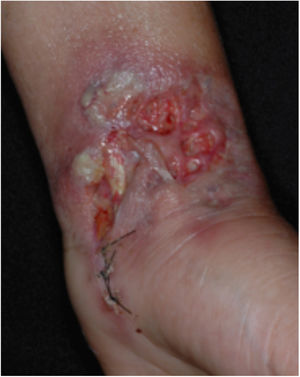 Classic or ulcerative pyoderma gangrenosum.