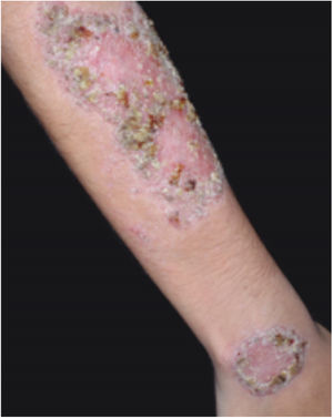 Vegetative or verrucous pyoderma gangrenosum in a patient with Behcet
