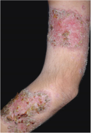 Vegetative or verrucous pyoderma gangrenosum in a patient with Behcet
