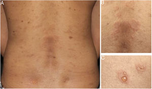 Clinical presentation of pemphigus herpetiformis (A). Annular urticarial plaques (B) and peripheral vesicles (C) in herpetiformis pattern on posterior trunk.