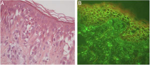 Pemphigus herpetiformis. (A) Eosinophilic spongiosis, without prominent acantholysis (Hematoxylin & eosin, x400). (B) Direct immunofluorescence with linear, intercellular, and intraepithelial IgG deposits.