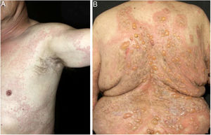 Urticarial (A) and bullous (B) phases of bullous pemphigoid.