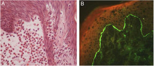 Bullous pemphigoid. (A) Focal eosinophilic spongiosis adjacent to subepidermal clefting (Hematoxylin & eosin, x400). (B) Direct immunofluorescence with linear deposits of IgG in the basement membrane zone.
