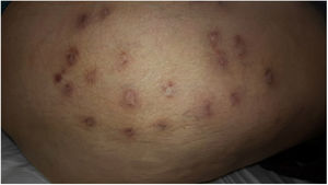 Residual scarring and discreet reddish aspect of nodular lesions after treatment with methotrexate, prednisone, and hydroxychloroquine. Thigh and right gluteus.