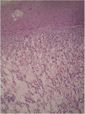Histology: intense inflammatory infiltrate of neutrophils with fibrin deposition (Hematoxylin & eosin, x100).