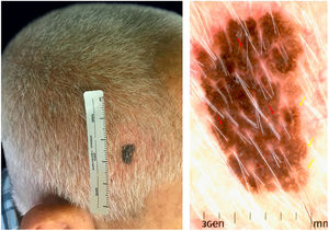 Clinical and dermatoscopic image of melanoacanthoma. (A) Clinical view: 9-mm asymmetric, dark-brown, sharply demarcated plaque on the right parietal. (B) Dermoscopic image with polarized light: presence of irregularly distribute dots (red arrow) and fat fingers (yellow arrow).