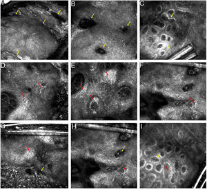 (A–I) Reflectance confocal microscopy of melanoacanthoma. (A–C) Findings suggestive of seborrheic keratosis (SK). (A) At the suprabasal epidermis level, a regular honeycomb pattern and epidermal projections (yellow arrow). (B) Keratin filled invaginations (yellow arrow). (C) At the dermo-epidermal junction (DEJ) level, densely packed round-to-polymorphous dermal edges (yellow arrow). (D–E) Findings suspected for melanoma. (D) At the suprabasal epidermis, a regular honeycomb pattern and dendritic pagetoid cells (red arrow). (E and F) At the DEJ level, an infiltration of dendritic cells around and between the dermal papillae (red arrow). (G–I) Findings present in SK (yellow arrow) and melanoma (red arrow).