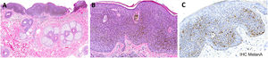 Histopathologic analysis and immunohistochemical stainings of the melanoacanthoma. (A) A hyperplastic epidermis, hyperkeratosis, and intense acanthosis. (B) Intermingled with the keratinocytes, dendritic melanocytes were present throughout the lesion. (C) Immunohistochemistry study confirming an increased density of melanocytes cells. (A and B) Hematoxylin & eosin stain; (C) Melan-A staining; original magnifications: A, x40, B–C, x400.