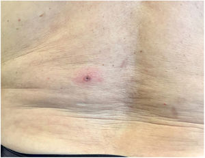 Multiple vesicular lesions affecting the left lumbar region.