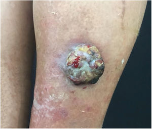 Fast-growing 3cm erythematous-violaceous nodule in right leg.
