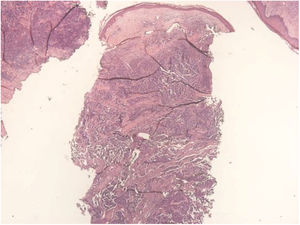 Dermal tumor with trabecular arrangement, composed of small blue cells with scarce cytoplasm and compact nuclei (Hematoxylin & eosin, x20).