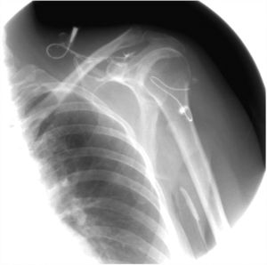 Irregular subcutaneous sinus tracts. A sinogram illustrating irregular sinus tracts extending from the cutaneous ulcers.