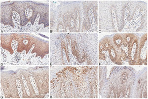 Immunohistochemical marking aspects of interleukins in psoriasis and geographic tongue: Interleukin-6 – A, Psoriasis; B, Geographic tongue in psoriatic patient; C, Geographic tongue. Interleukin-17 – D, Psoriasis; E, Geographic tongue in psoriatic patient; F, Geographic tongue. Interleukin-23 – G, Psoriasis; H, Geographic tongue in psoriatic patient; I, Geographic tongue.