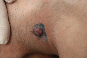 Blue-black colored melanocytic macule with a pinkish tumor on top of it.