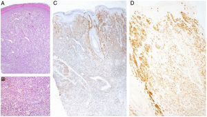 (A) Hematoxylin & eosin staining (x20) found a well-circumscribed, non-inflammatory dermal mass with atypical melanocytes, and no epidermal connection. (B) Hematoxylin & eosin staining (x40) showed atypical melanocytes. (C) Melan-A immunohistochemical staining. (D) HMB-45 immunohistochemical staining.
