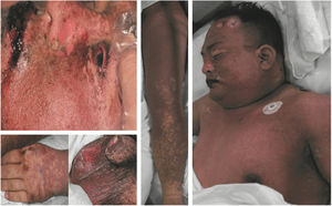 Dermatological manifestations of a patient with toxic epidermal necrolysis.