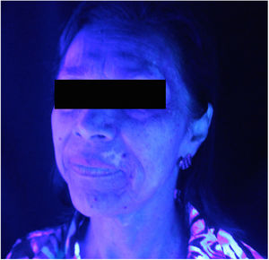 Vitiligo on the face, front position (Wood