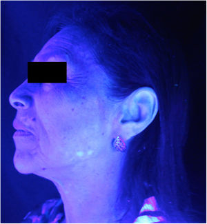 Vitiligo on left hemiface (Wood