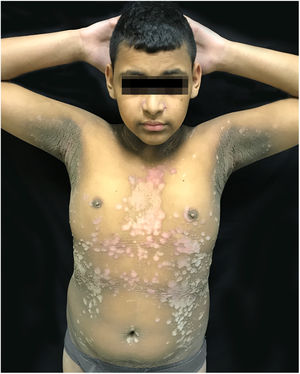 Erythematous, verrucous plaques, distributed on the trunk and abdomen.