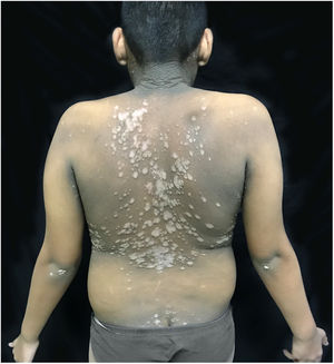 Erythematous, verrucous plaques, distributed on the trunk and abdomen.