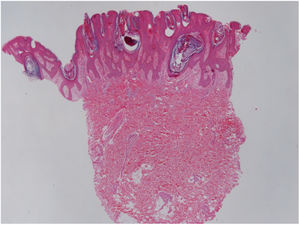 Skin sections showing a papillomatous surface covered by lamellar corneal layer with numerous spores of Malassezia spp. (Hematoxylin & eosin, x40)
