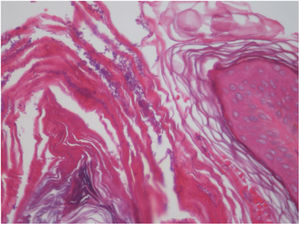 Malassezia spp. spores in the stratum corneum (Hematoxylin & eosin, x400) .