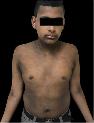 Outcome after treatment, improvement of lesion