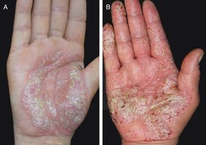 Clinical picture: palmoplantar pustulosis rash on hands: (A) patient with c.140A>G/p.Asn47Ser heterozygous mutation; (B) patient with no mutation of IL36RN.