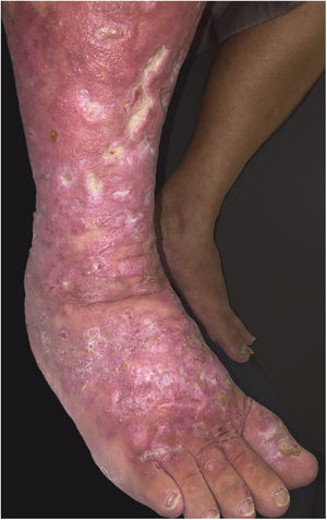 Infiltrated, ring-shaped, erythematous plaques with ulcerations, on the right leg and foot.