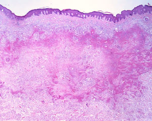 Histopathological examination shows palisade granuloma, consisting of epithelioid histiocytes and multinucleated giant cells, centered by fibrinoid necrosis, with some neutrophils and signs of vascular damage in the dermis. (Hematoxylin & eosin, ×40).
